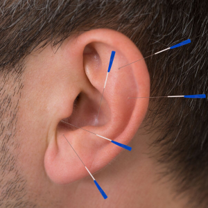 FastTrack NADA Style Addiction Protocol