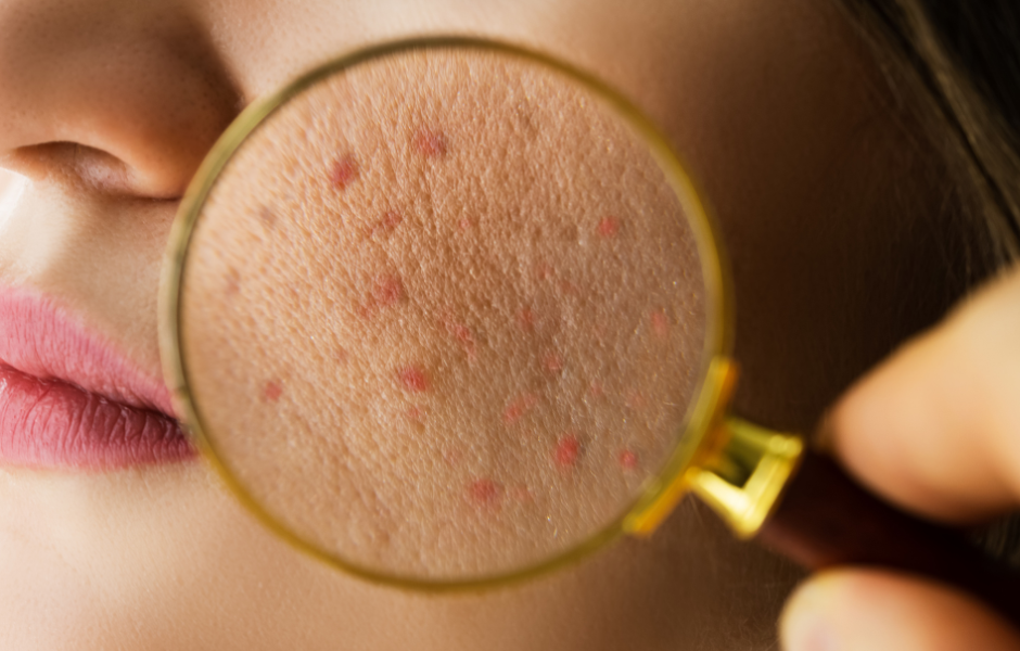 Exploring the benefits of TCM in Dermatology